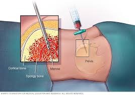 Leukemia Diagnosis