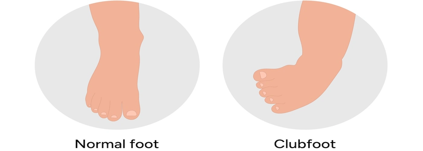 child with clubfoot